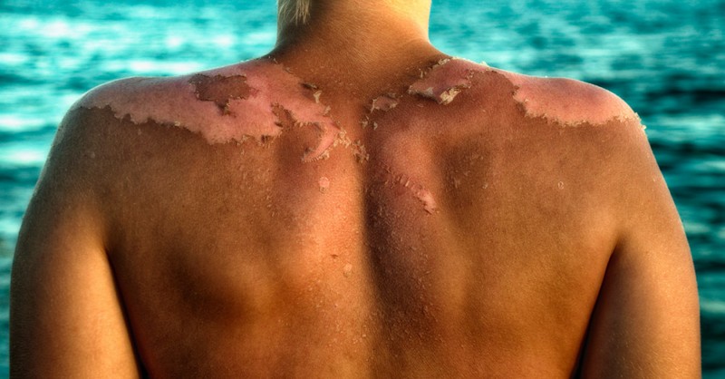Jak může opalovací krém způsobit rakovinu kůže a ne slunce
